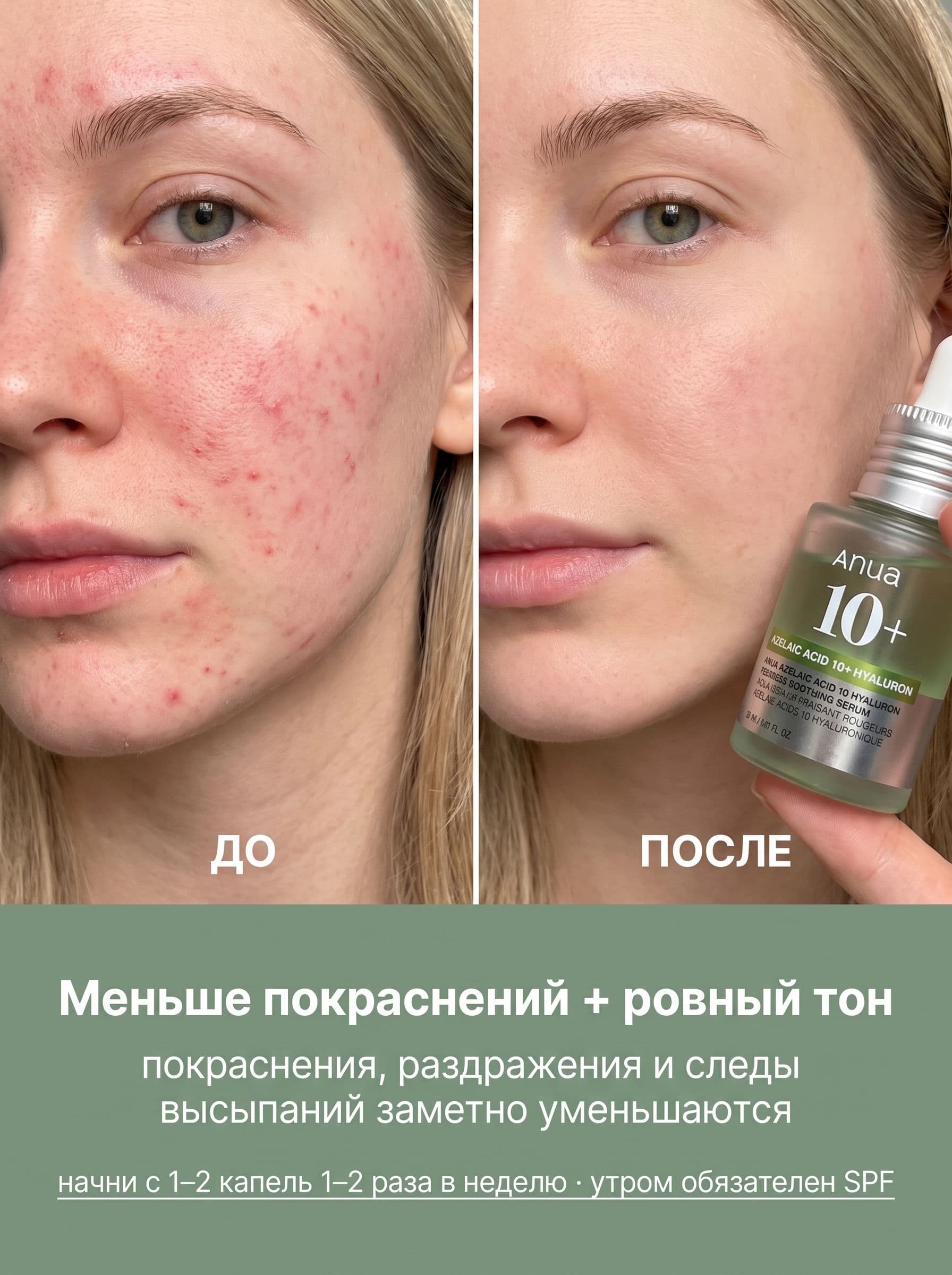 Азелаиновая кислота 10%: как Anua справляется с покраснениями и постакне — фото 3